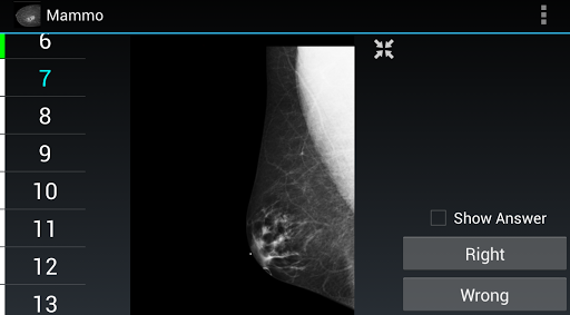 Radiology Flashcards: Mammo