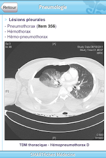 How to install SMARTfiches Pneumologie Free 1.08 unlimited apk for pc