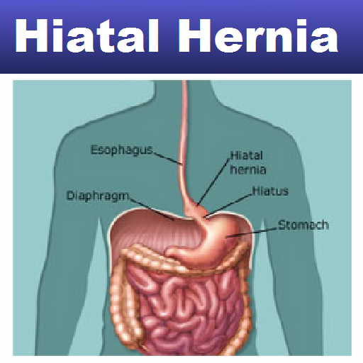 Hiatal Hernia Symptoms - Diet 書籍 App LOGO-APP開箱王