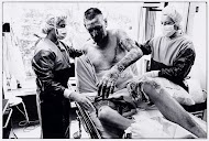 Brandwondenpatiënt voor de behandeling