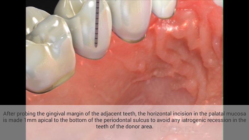 Periodontal Advanced Surgery Screen 2