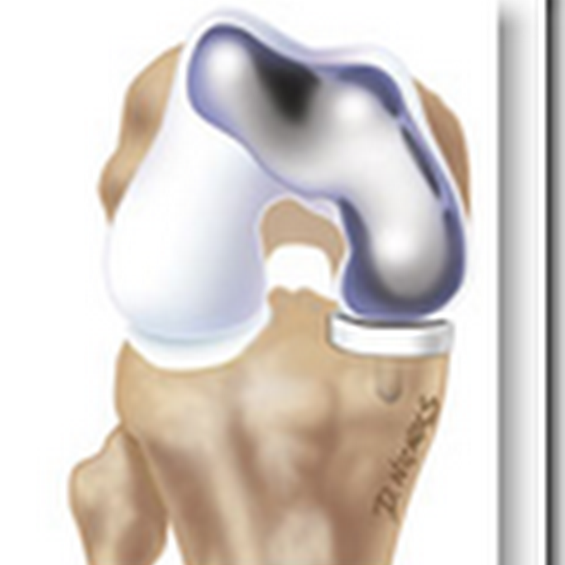 First Patient-Specific Knee Resurfacing System on the Market
