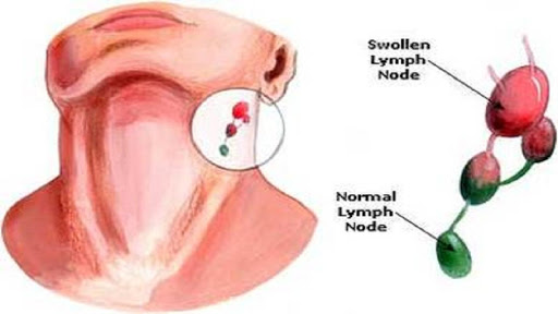 免費下載健康APP|How to Get Rid of Sore Throat app開箱文|APP開箱王