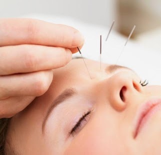 acupuncture