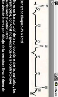 Electrocardiograma ECG Tipos(圖4)-速報App