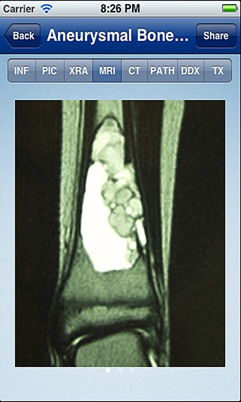 Tumorpedia Bone Screen 2