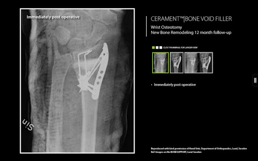 免費下載醫療APP|Cerament Bone Healing app開箱文|APP開箱王