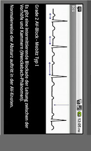 Elektrokardiogramm EKG Typen(圖3)-速報App