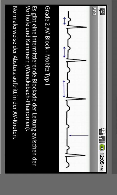 Elektrokardiogramm EKG Typen Screen 3