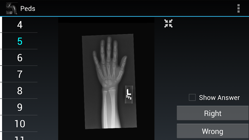 Radiology Flashcards: Peds Screen 1