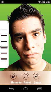 Free Pimple Remover APK for Android