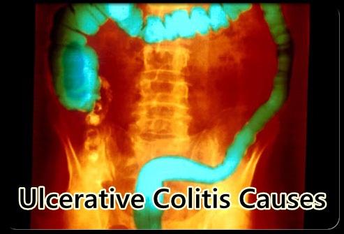 免費下載醫療APP|Ulcerative Colitis Causes app開箱文|APP開箱王