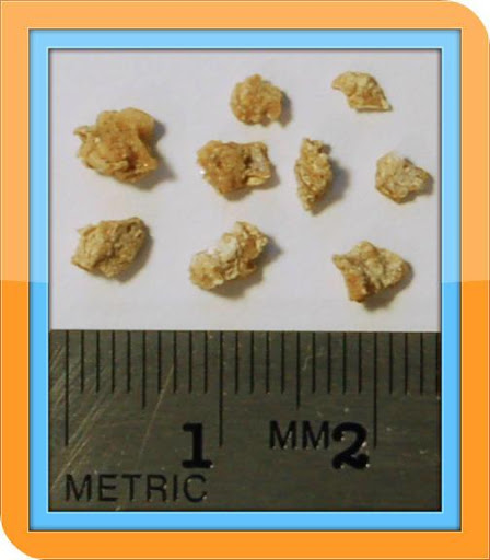 Kidney Stones - Guide