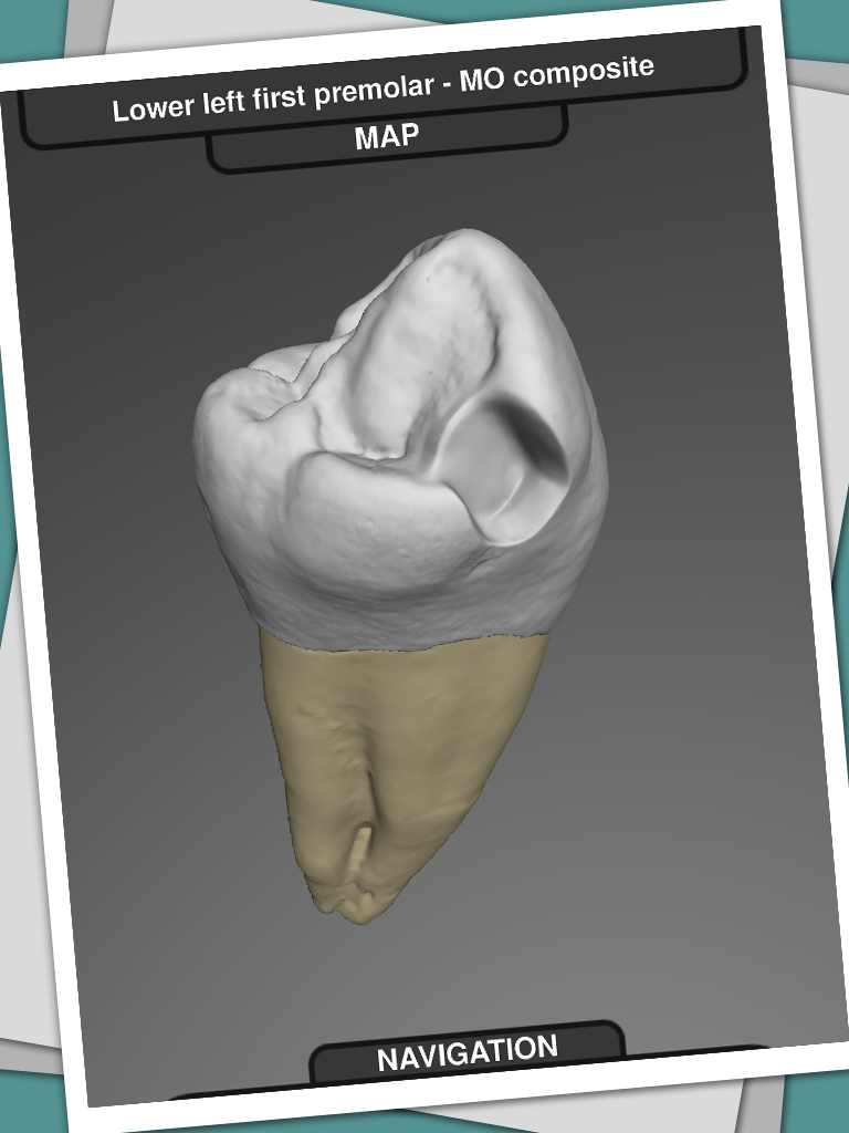 CavSim - Dental Cavity Preps Screen 2