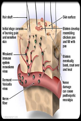 Shingles Symptoms Treatment