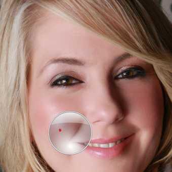 Blemish Remover Photo Android