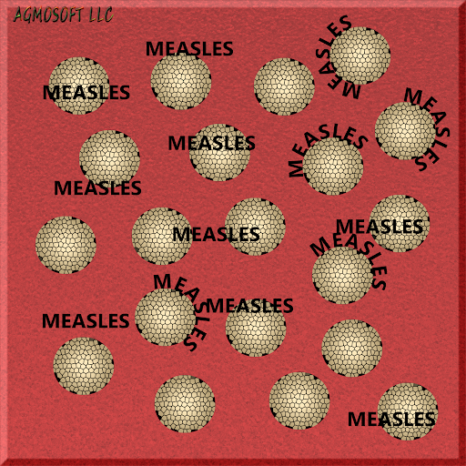 Measles