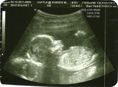 Baby 1 Profile @ 17 weeks