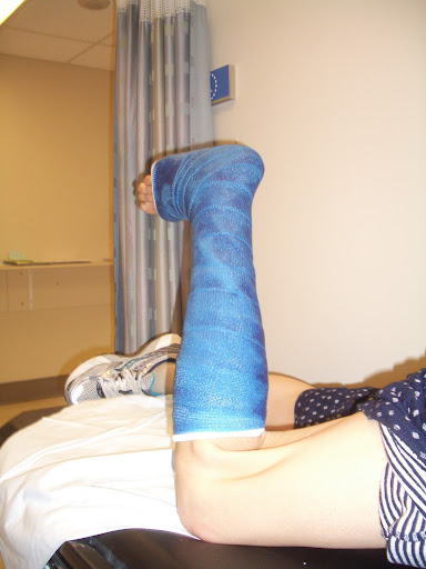 Documenting My Posterior Tibial Tendon Surgery and Recovery: Stitches ...