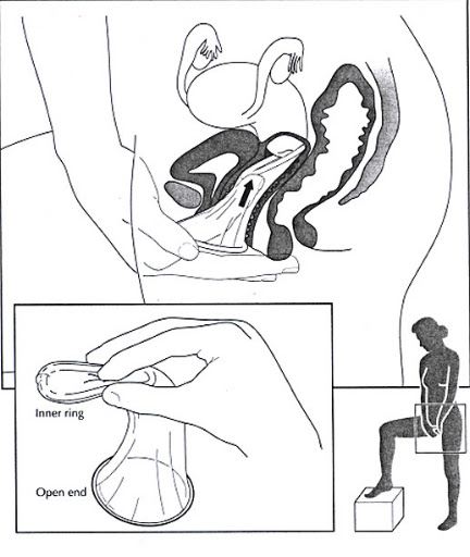 The Female Condom