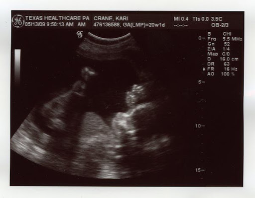13 weeks pregnant. 20 weeks pregnant, and she#39;s