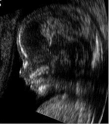 [220px-Embryo_at_14_weeks_profile[4].jpg]