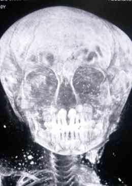 An x-ray of the mummy's skull. Picture courtesy of Addenbrooke's Hospital.