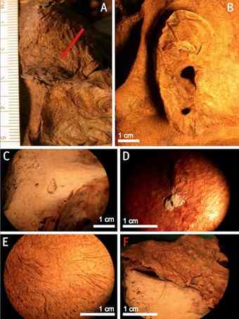 The mummified head reveals A) Henry IV's mole, B) the king's pierced ear, C) a bone lesion caused by a failed murder attempt, D) deposits on the scalp left from molds taken of the king's head, E) a red mustache and F) red hair. Credit: Philippe Charlier/British Medical Journal