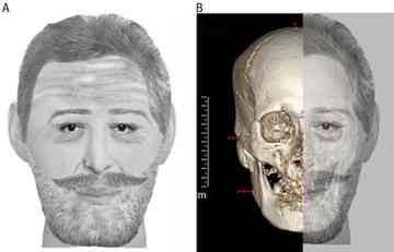 A reconstruction of the mummified skull matched Henry IV's features. Credit: Philippe Charlier/British Medical Journal.