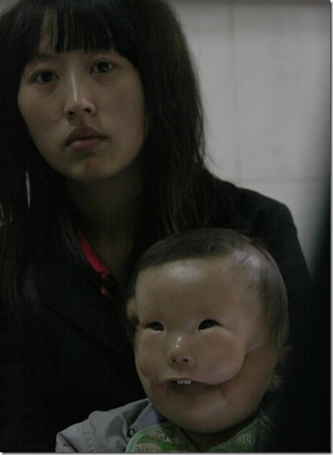 Transverse facial cleft  Boy Photo 1