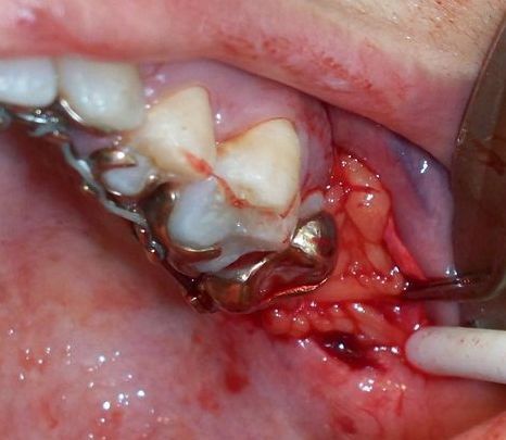 Buccal fat pad sutured in order to 