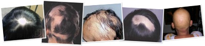View Different stages of Alopecia