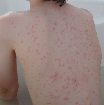 Chicken pox is a very itchy rash caused by the varicella virus.