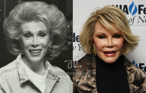 joan rivers antes y despues de la cirugia plastica