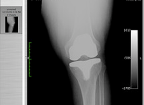 Internet en la Rehabilitación de la artroplastia total de rodilla.