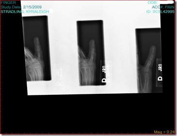 Kyra's broken finger1