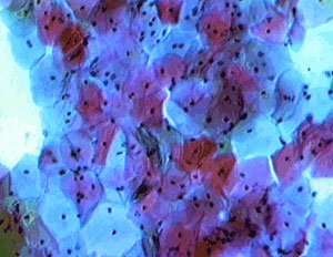 cervical cancer remedy america