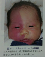 Sturge Weber症候群 Orthoptics