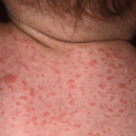 Skin rashes (spots). Kids logo