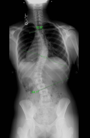 [Logans x-rays before surgery-crop[3].jpg]