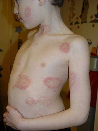 Photo microbiology fungus ringworm