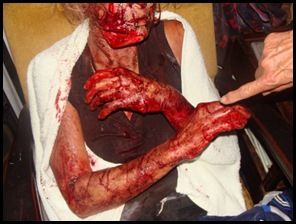 Viljoenskroon farm attack victim panga injuries Jan 25 2010 pic Carien Somers Dippenaar Facebook