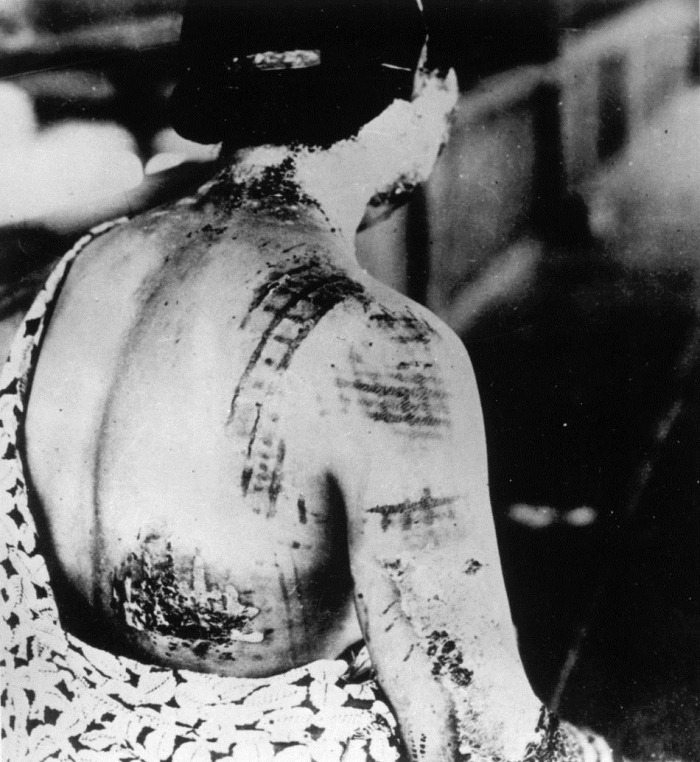 HIROSHIMA  A-BOMB VICTIM WWII