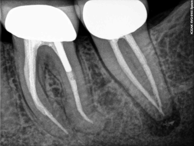 [Endodontic Complexity preop[5].jpg]