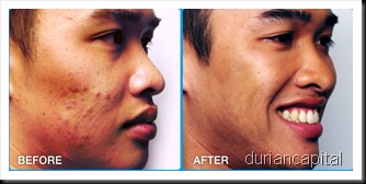 acne-before-after-picture1