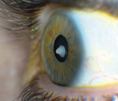 [cataracts[2].jpg]