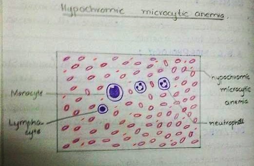 [hypchromic microcytic anemia H&E diagram[2].jpg]
