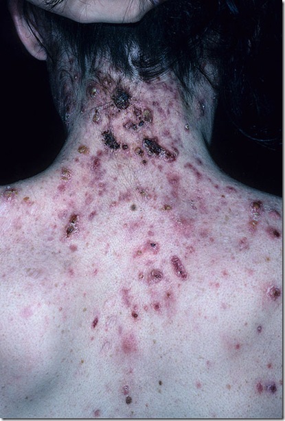 acne-cystic-101