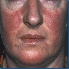 acne face