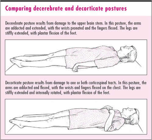 Decerebrate Rigidity Www Picswe Com Aayusha Decerebrate Posture Rigidity Abnormal Extensor Jpg 499x458